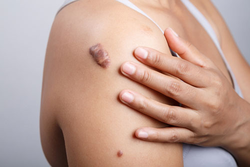 Keloid Removal & Treatment London 1