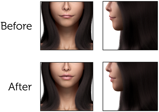 Lip-Enhancement-(Female)-1