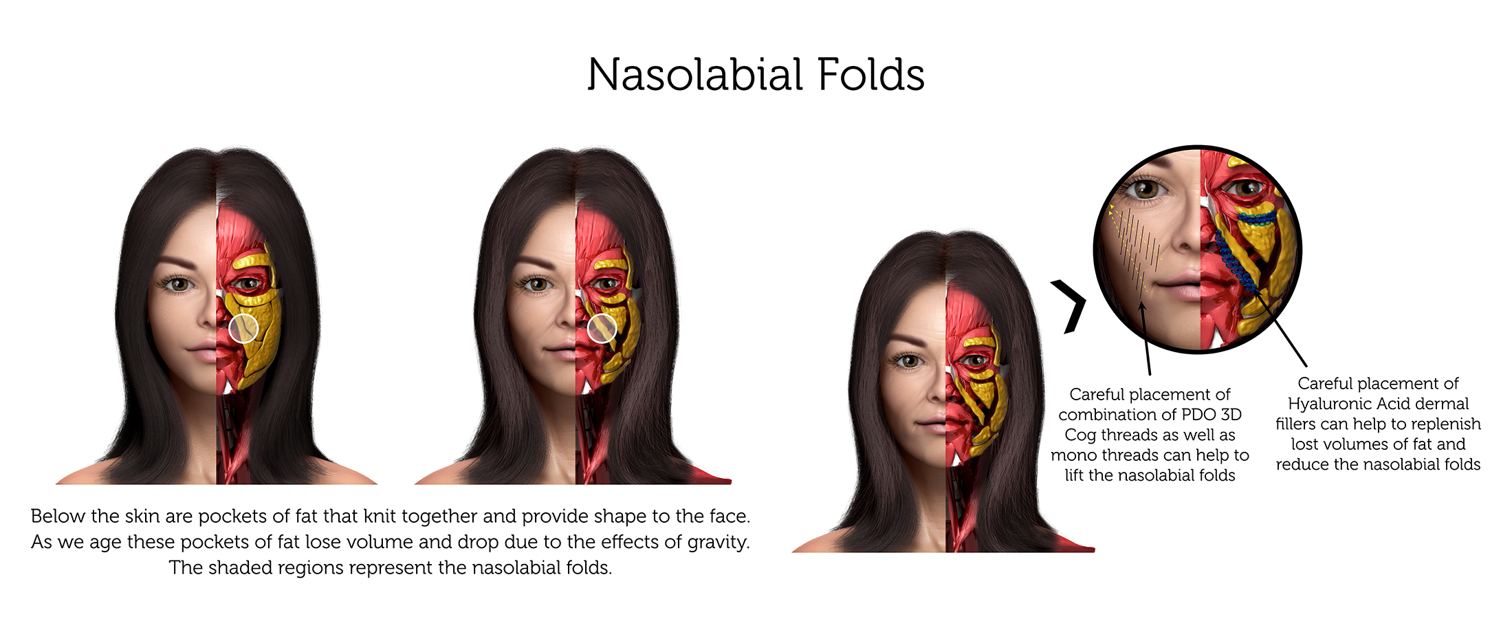 Nasolabial Folds (Female) ab-01