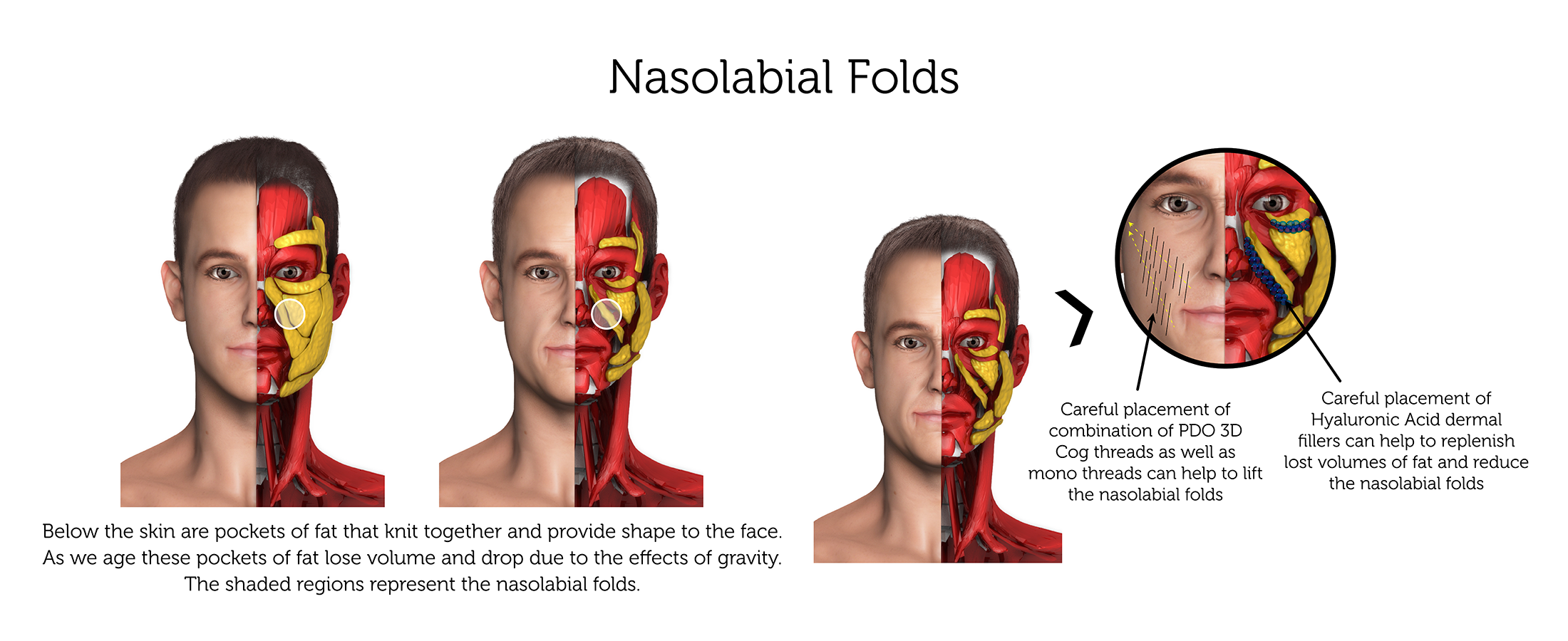 Nasolabial Folds (Male) ab-01