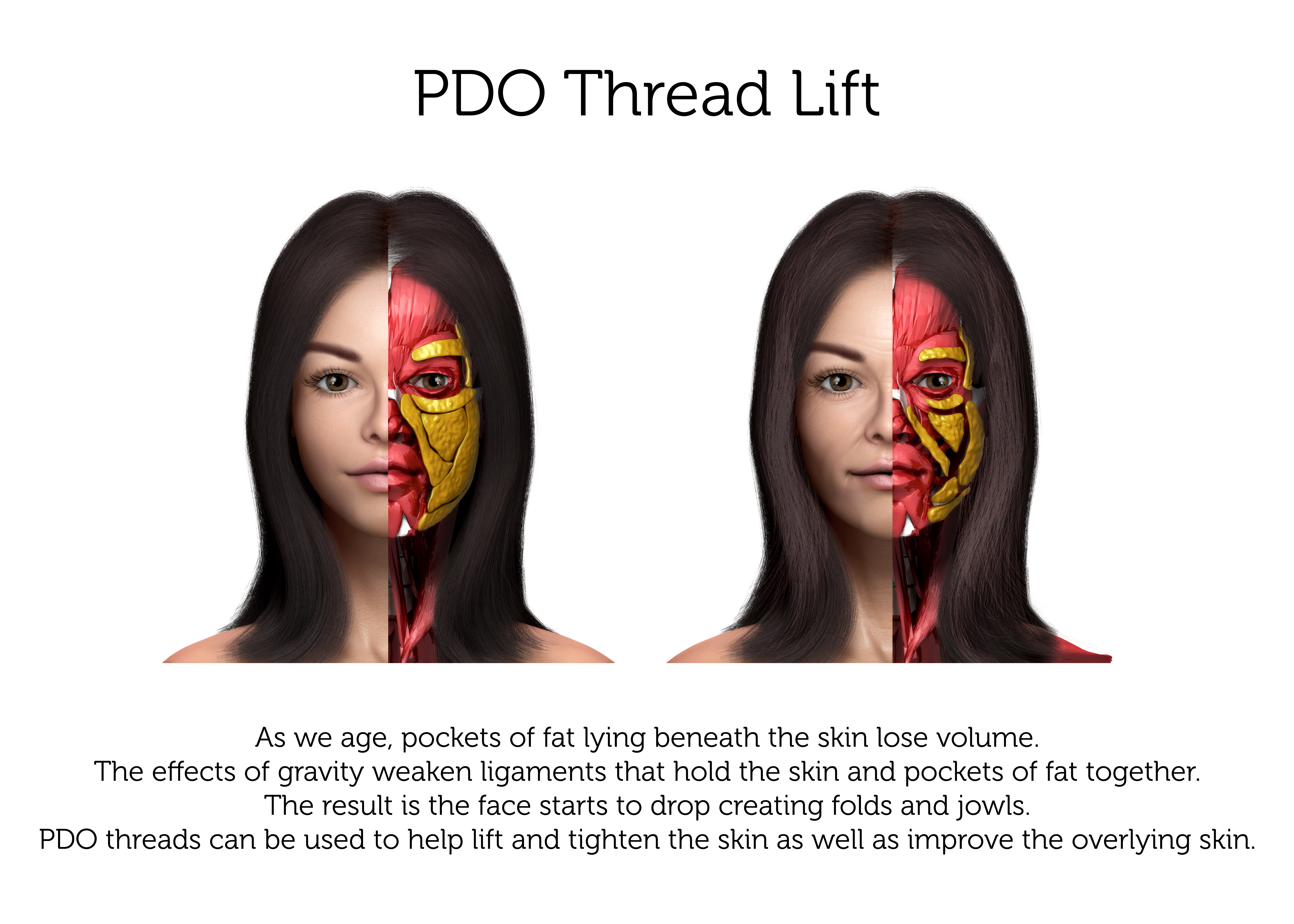 PDO Thread Lift (Female)-01