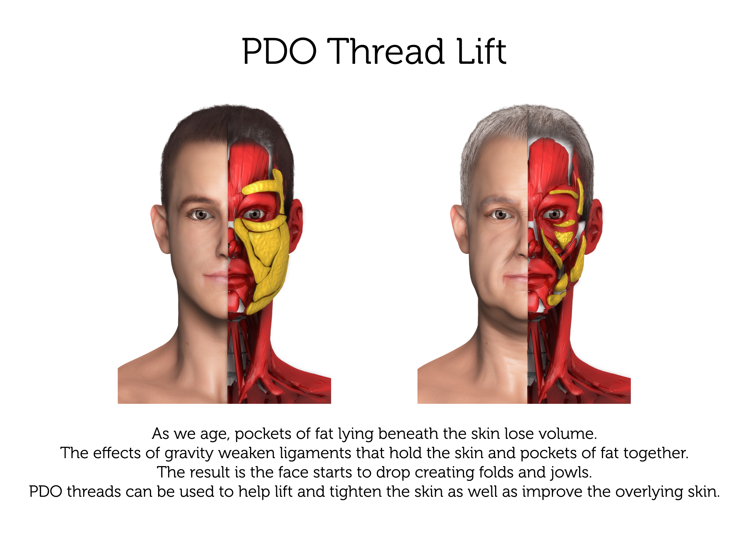 PDO-Thread-Lift-(Male)