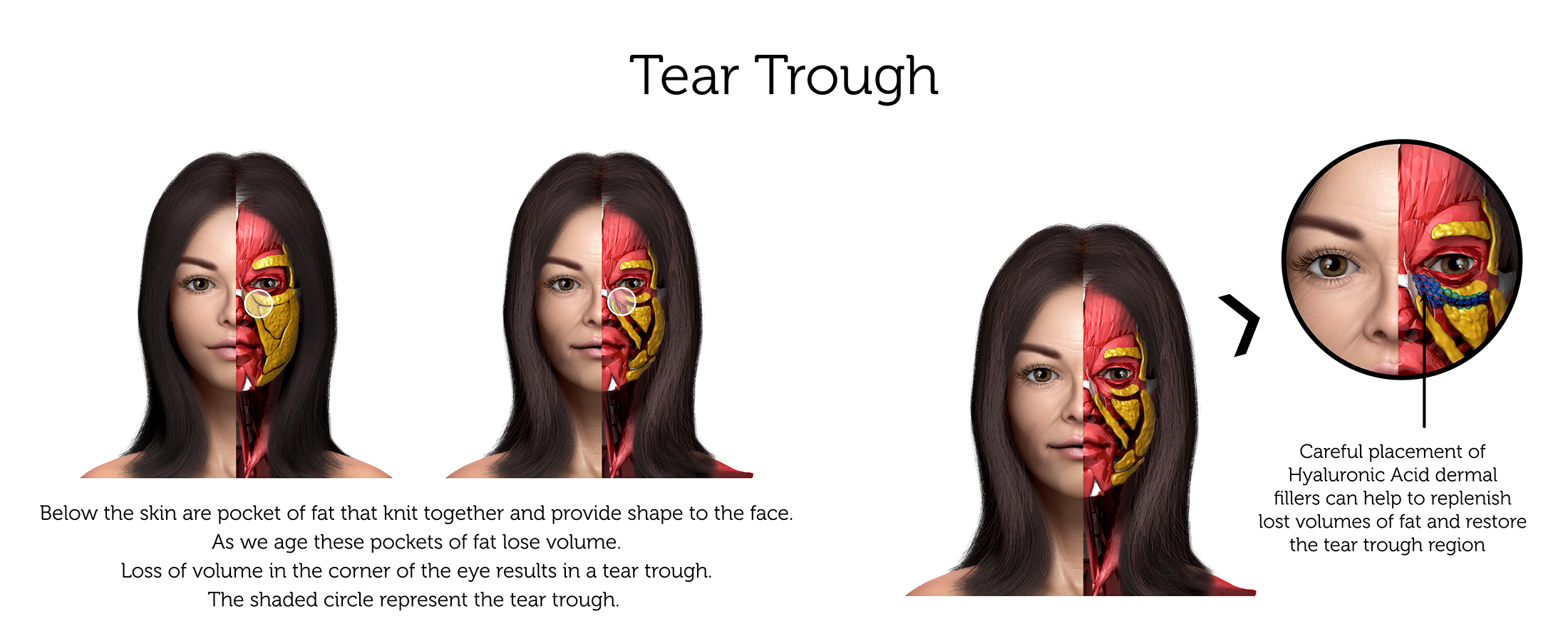 Tear Trough (Female) ab-01