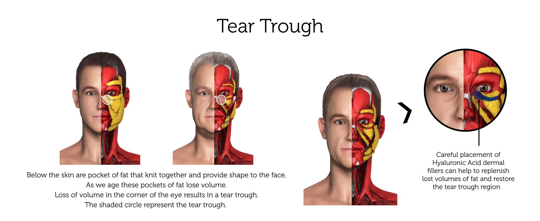Tear Trough (Male) ab-01