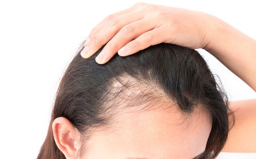 Female Pattern Hair Loss Treatment | Rejuvence Clinic