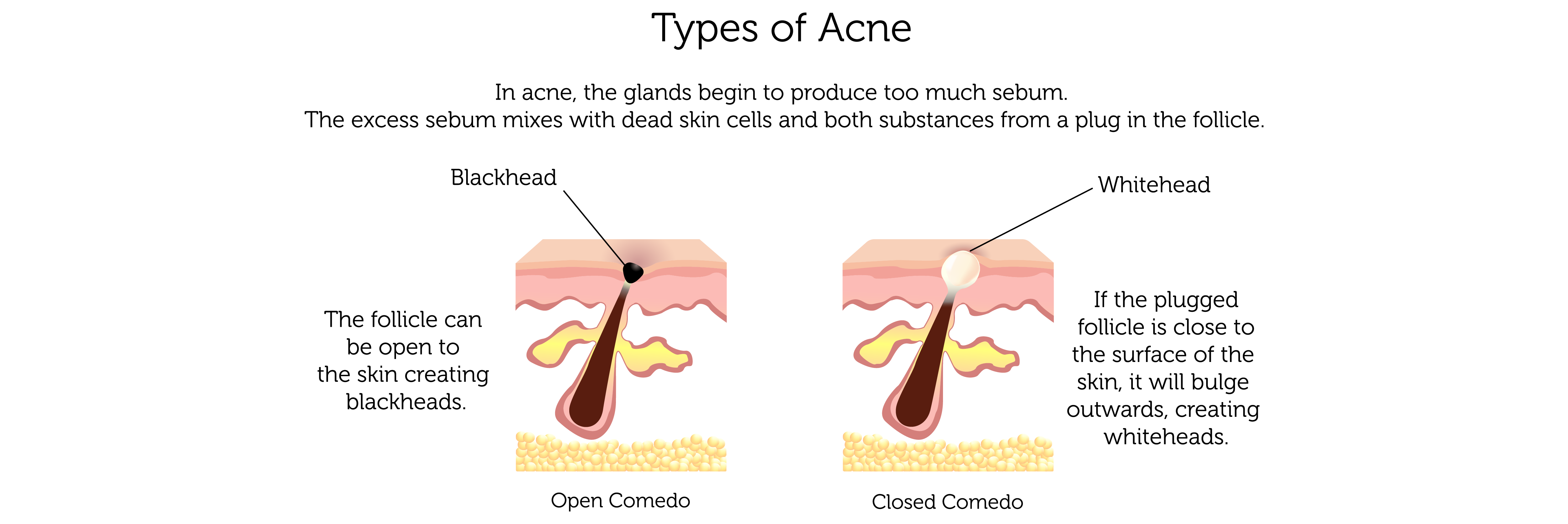 Acne Types (b)-01