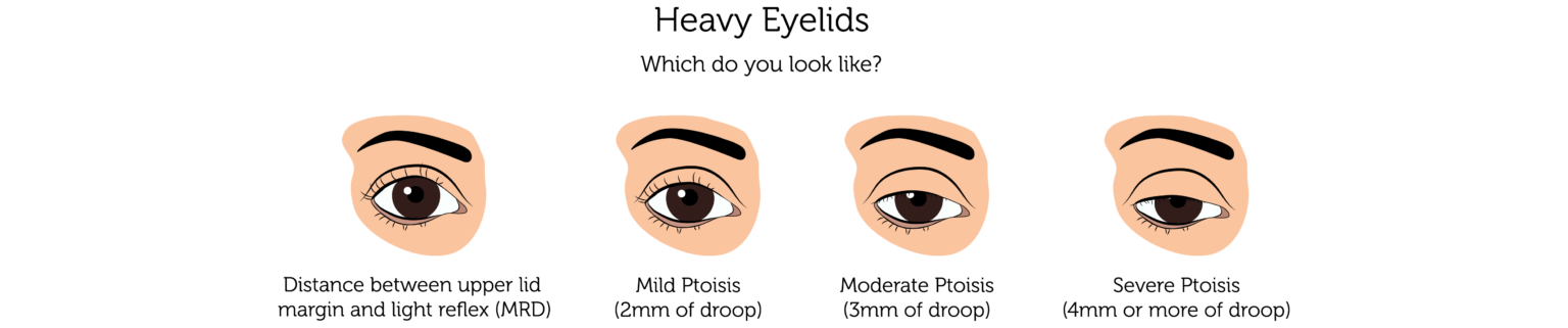 Heavy eyelids london rejuvence clinic
