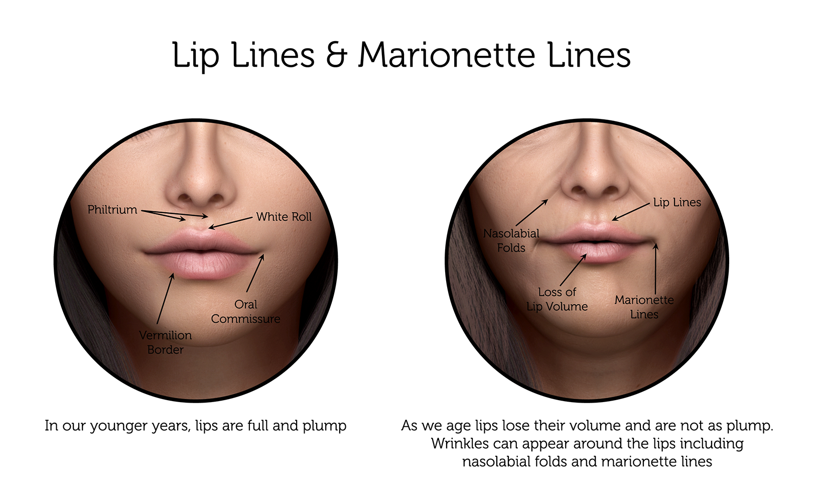 Lip-Lines-_-Marionette-Lines-(Female)