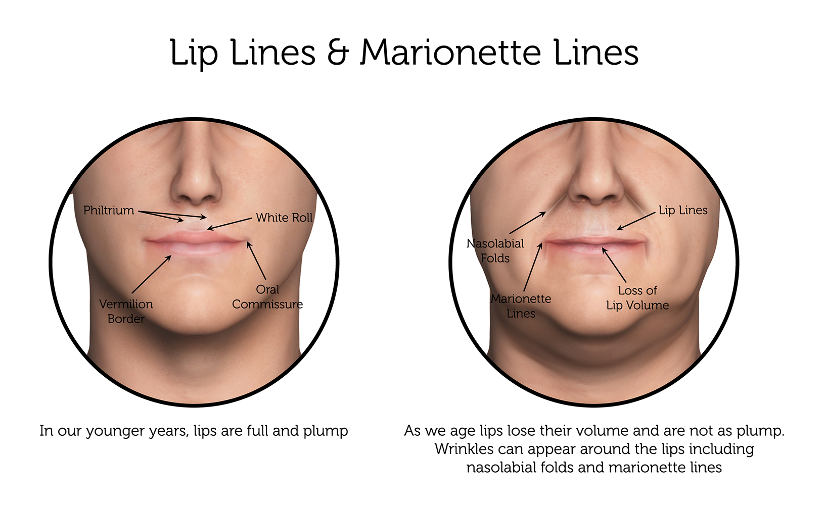 Lip-Lines-_-Marionette-Lines