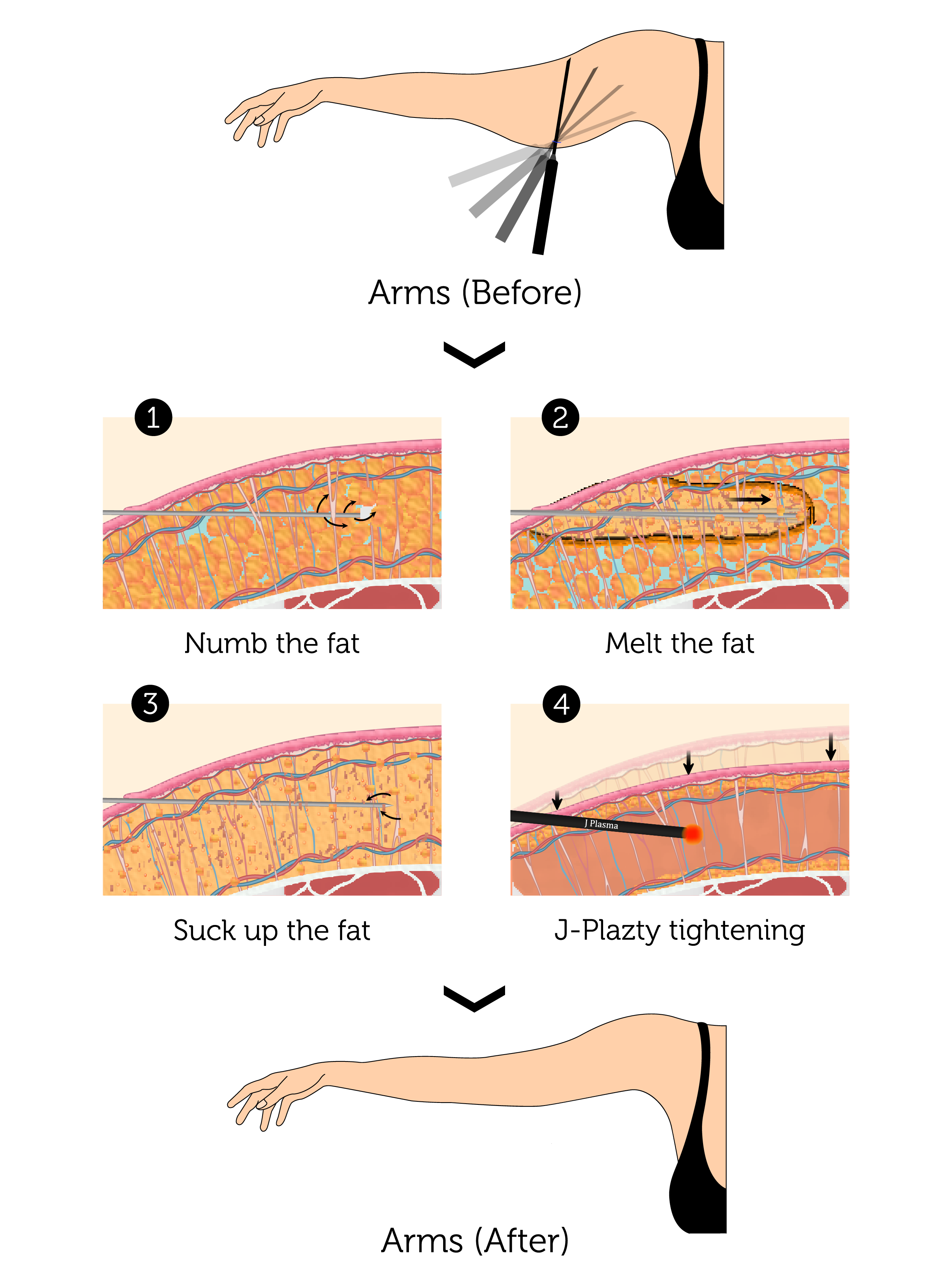 J-Plazty Arms (Female)-01