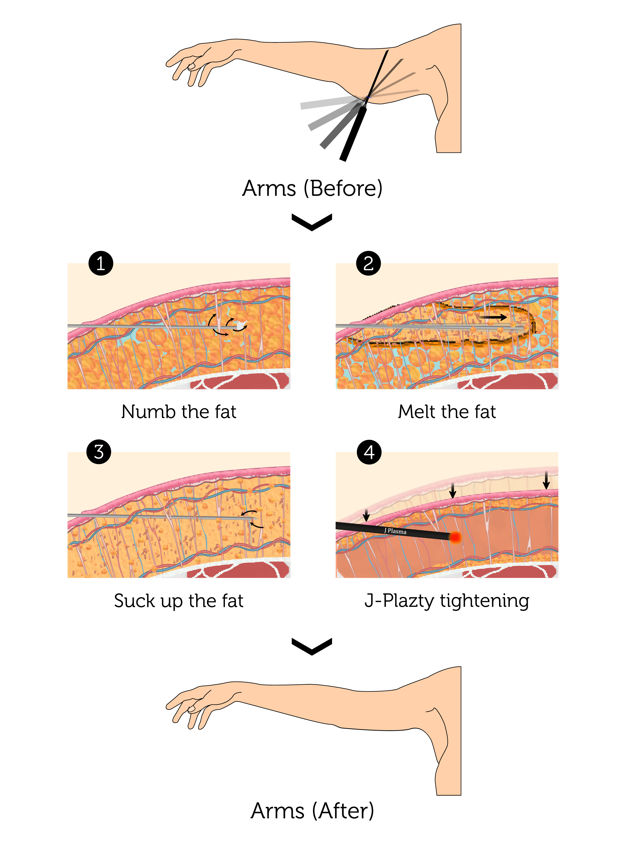 J-Plazty Arms (Male)-01