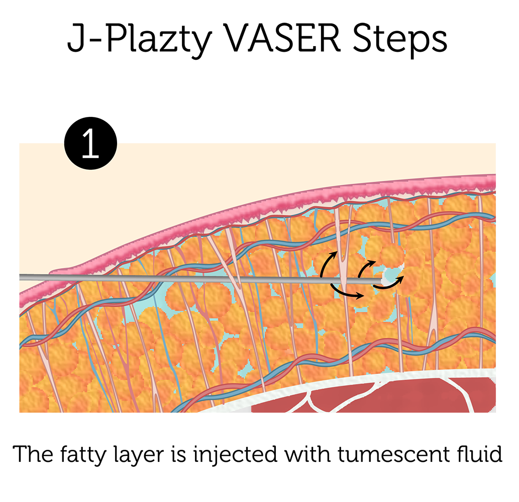 J Plazty VASER Steps 1-01