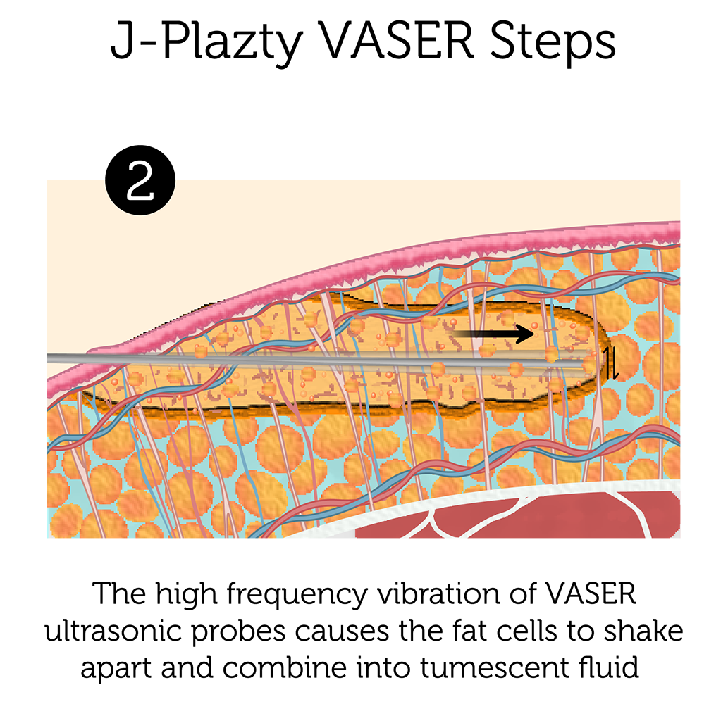 J Plazty VASER Steps 2-01