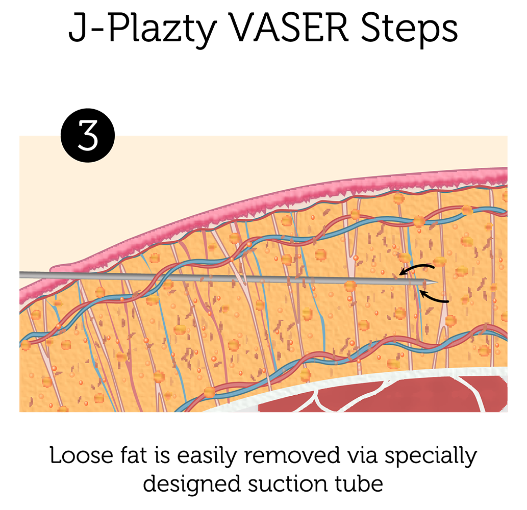J Plazty VASER Steps 3-01