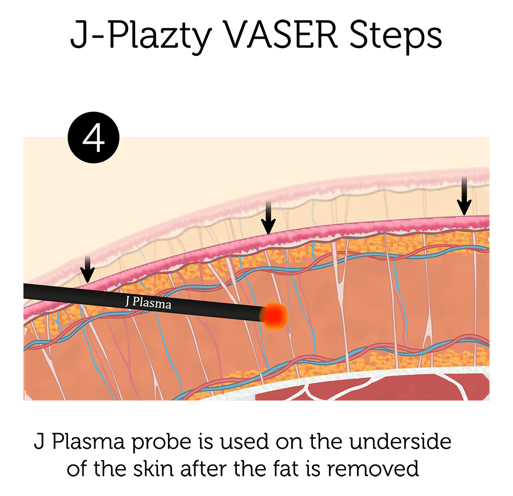 J Plazty VASER Steps 4-01