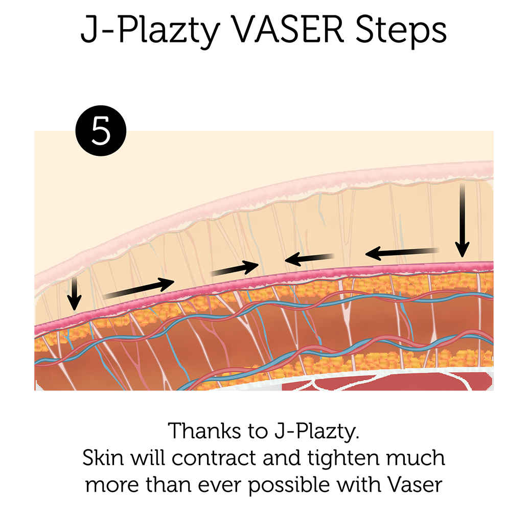 J Plazty VASER Steps 5-01