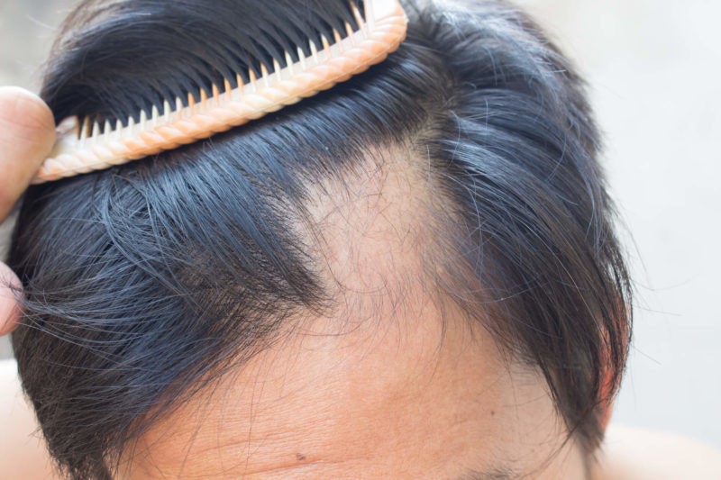 Male Pattern Hair Loss Treatment | Androgenic Alopecia | Rejuvence Clinic