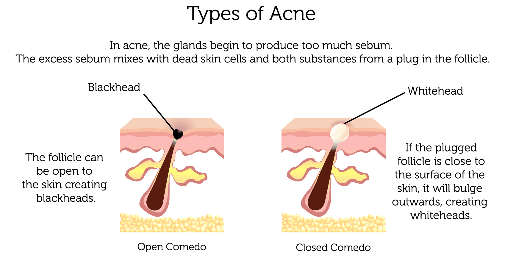 Acne Types 2-01