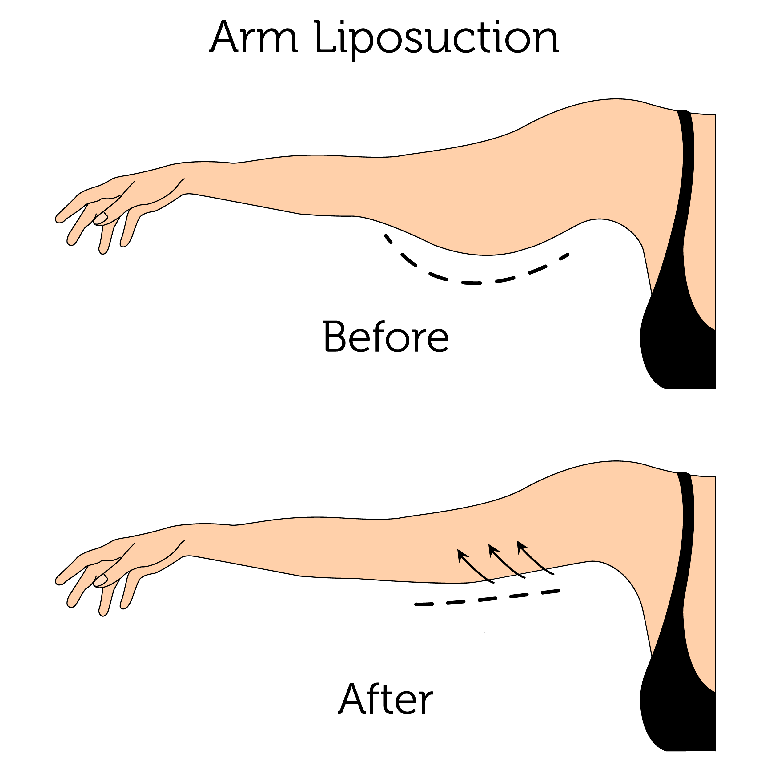 Arm Liposuction (Female)-01