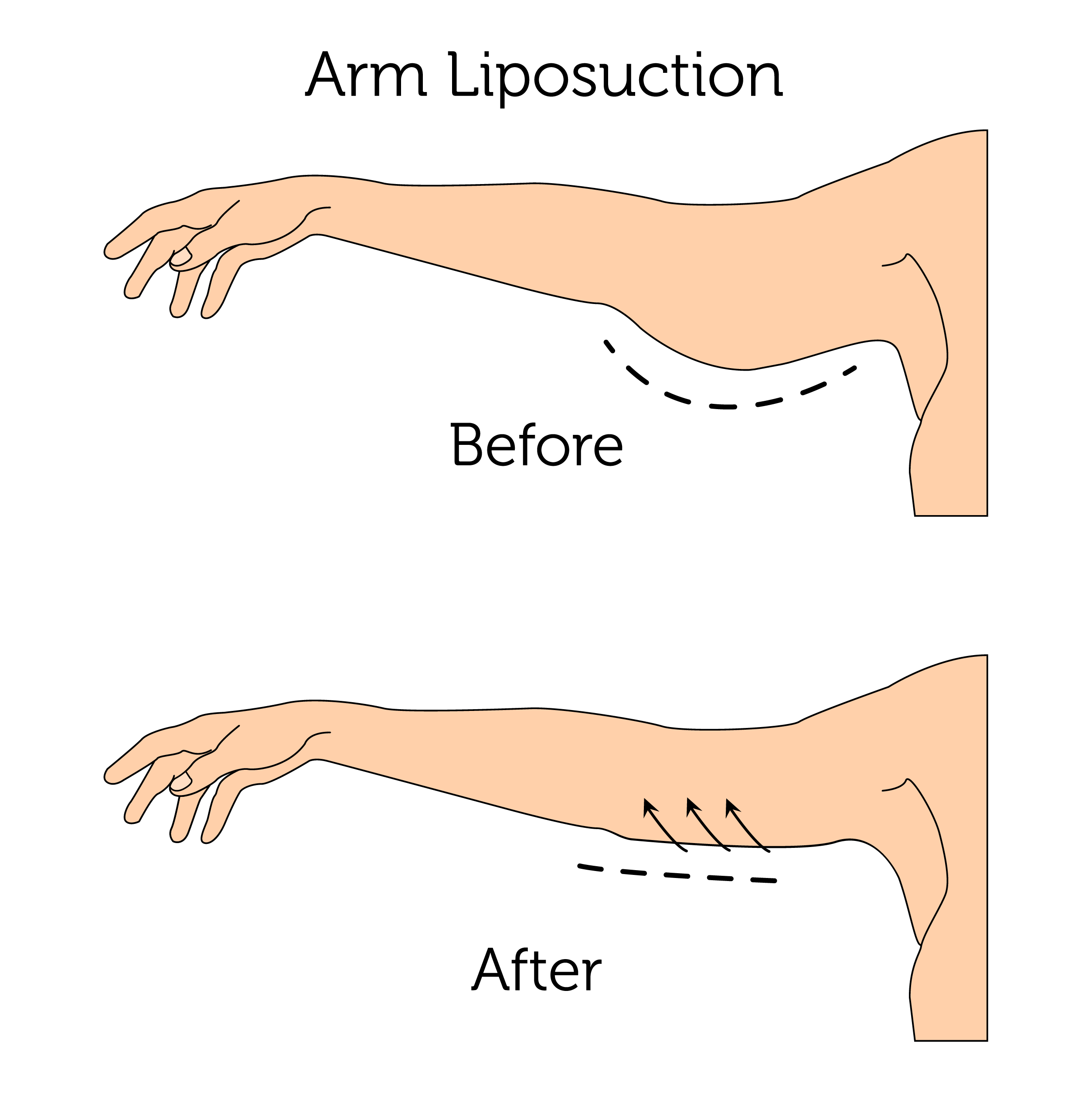 Arm Liposuction (Male)-01