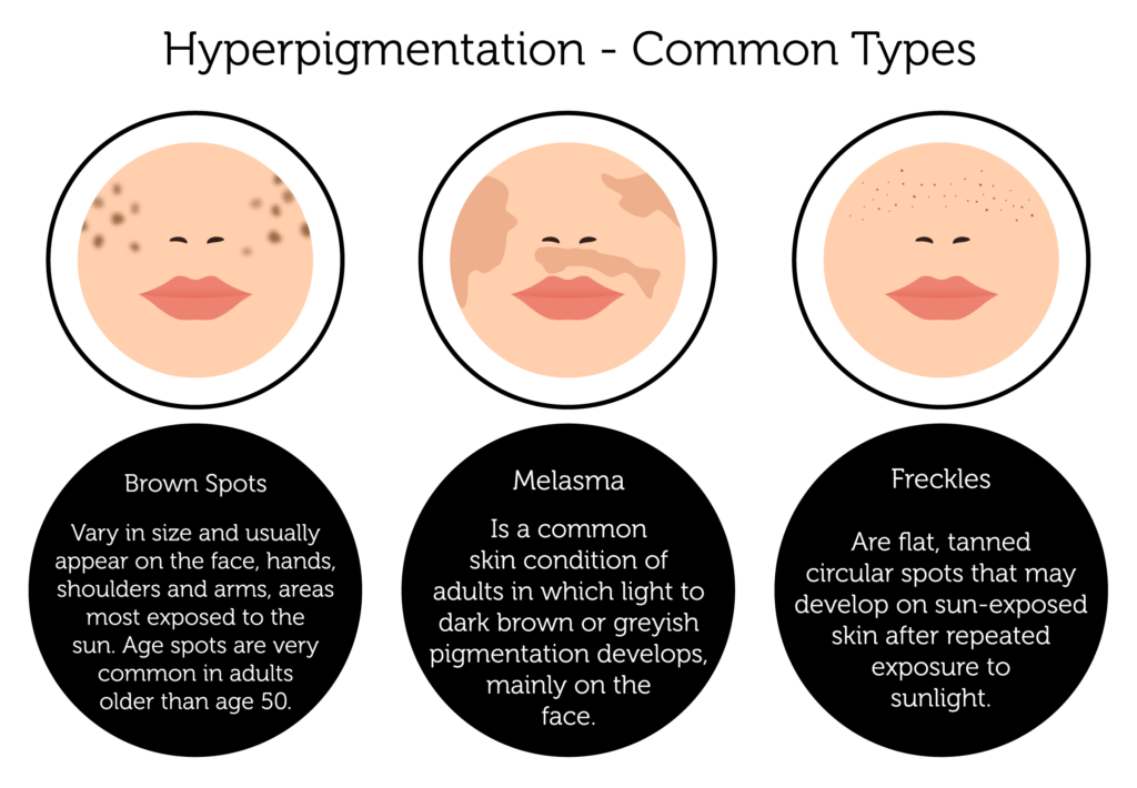 Skin Pigmentation Treatment in London Rejuvence Clinic