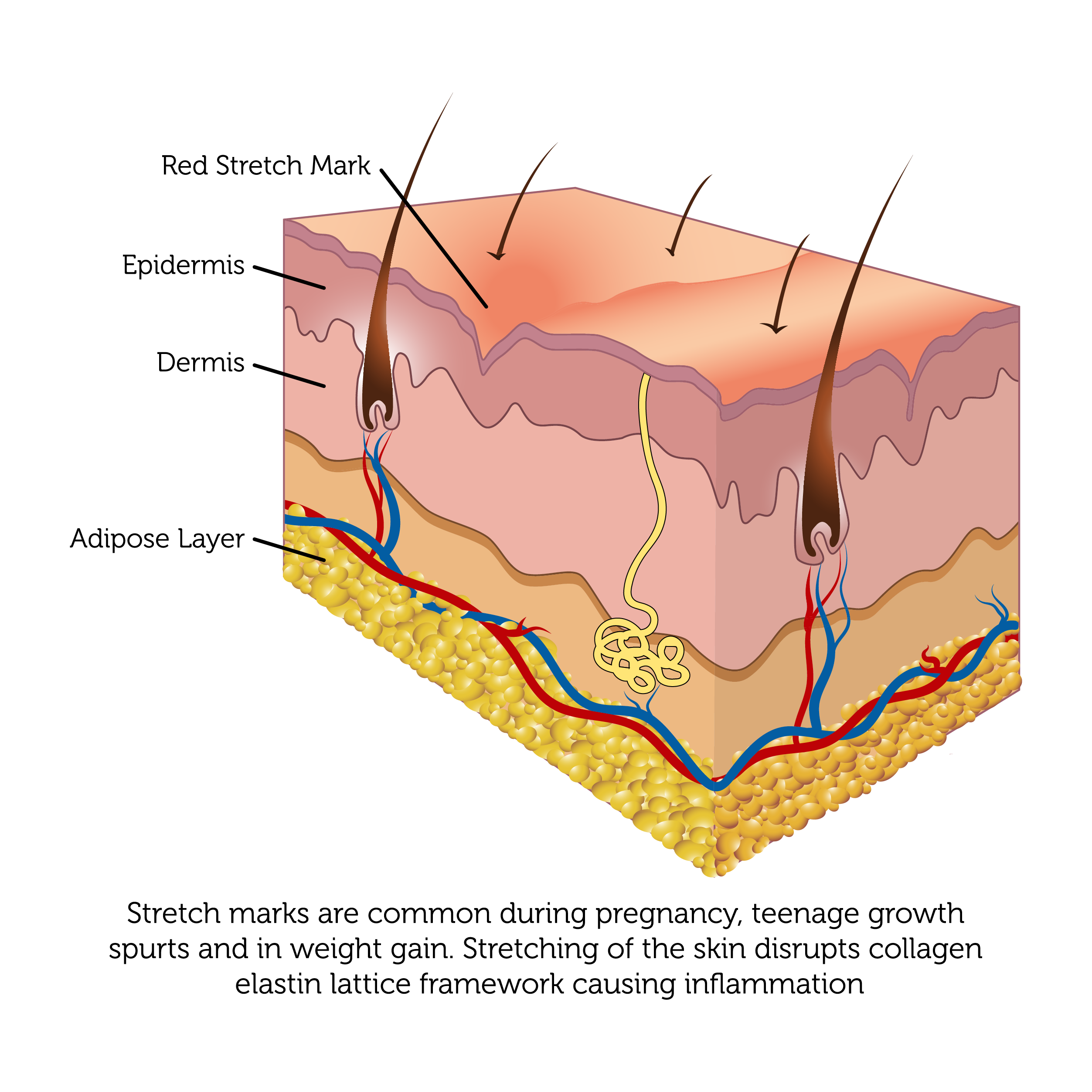 Laser Treatments for Stretch Marks in London