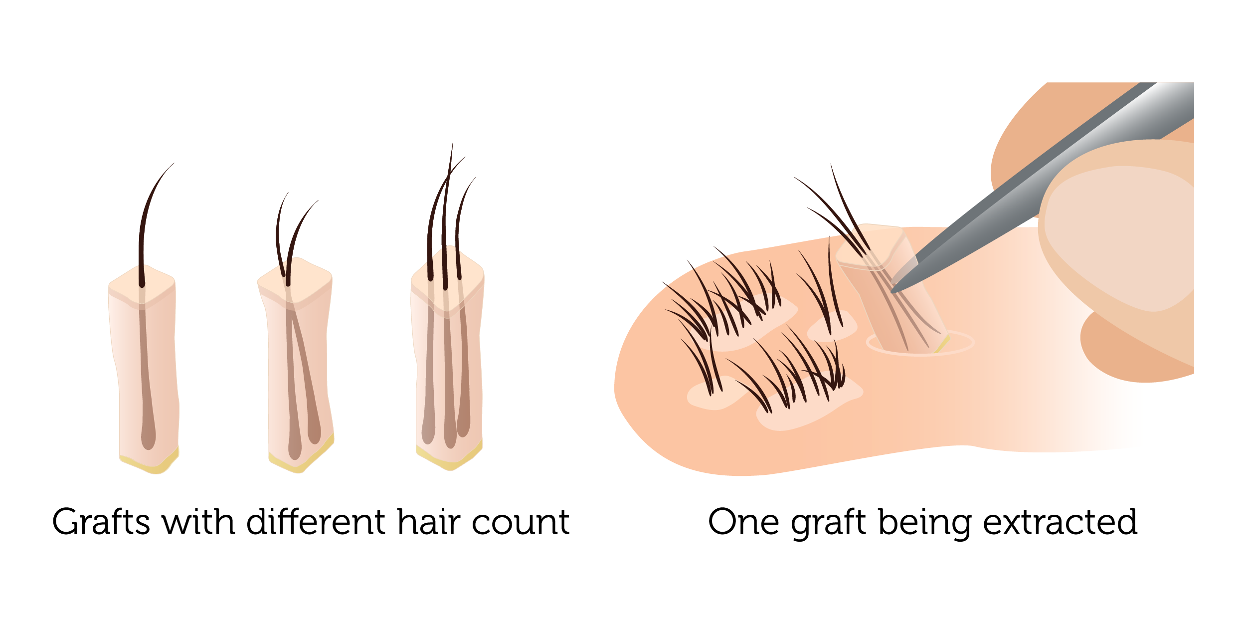 FUE Hair Transplant UK | ISHRS | Rejuvence Clinic