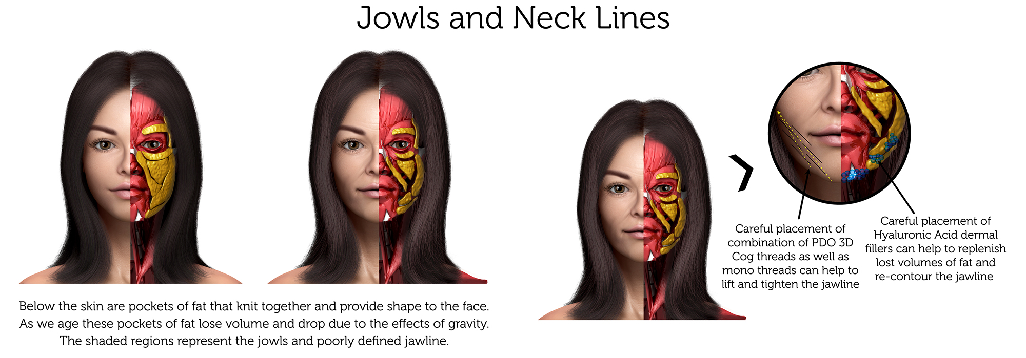 Jowls and Neck Lines (Female) a-01