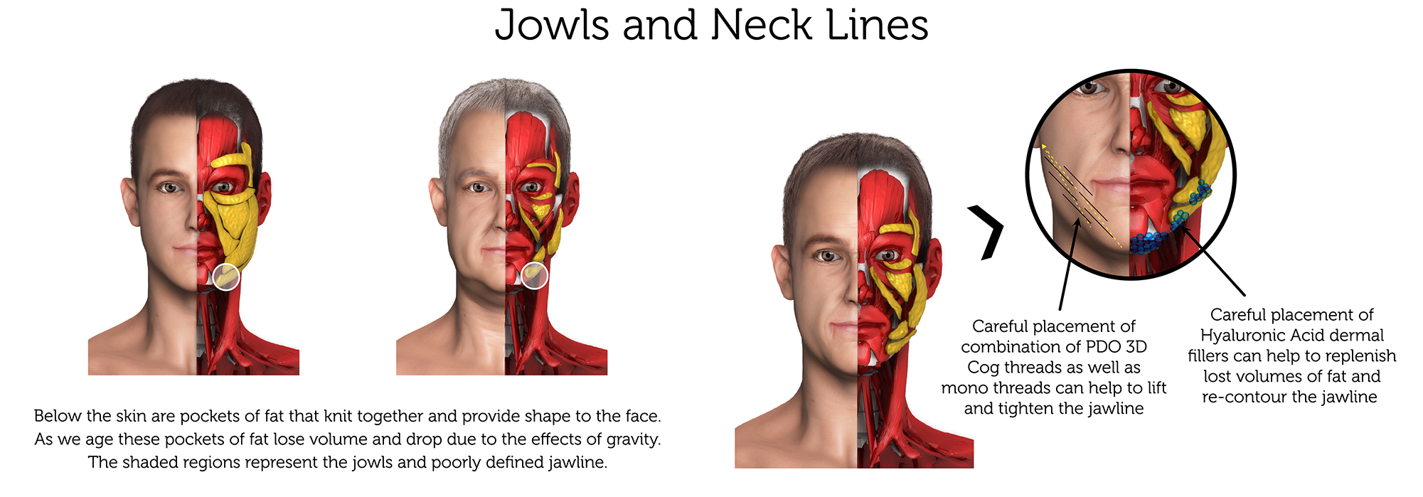 Jowls and Neck Lines (Male) a-01