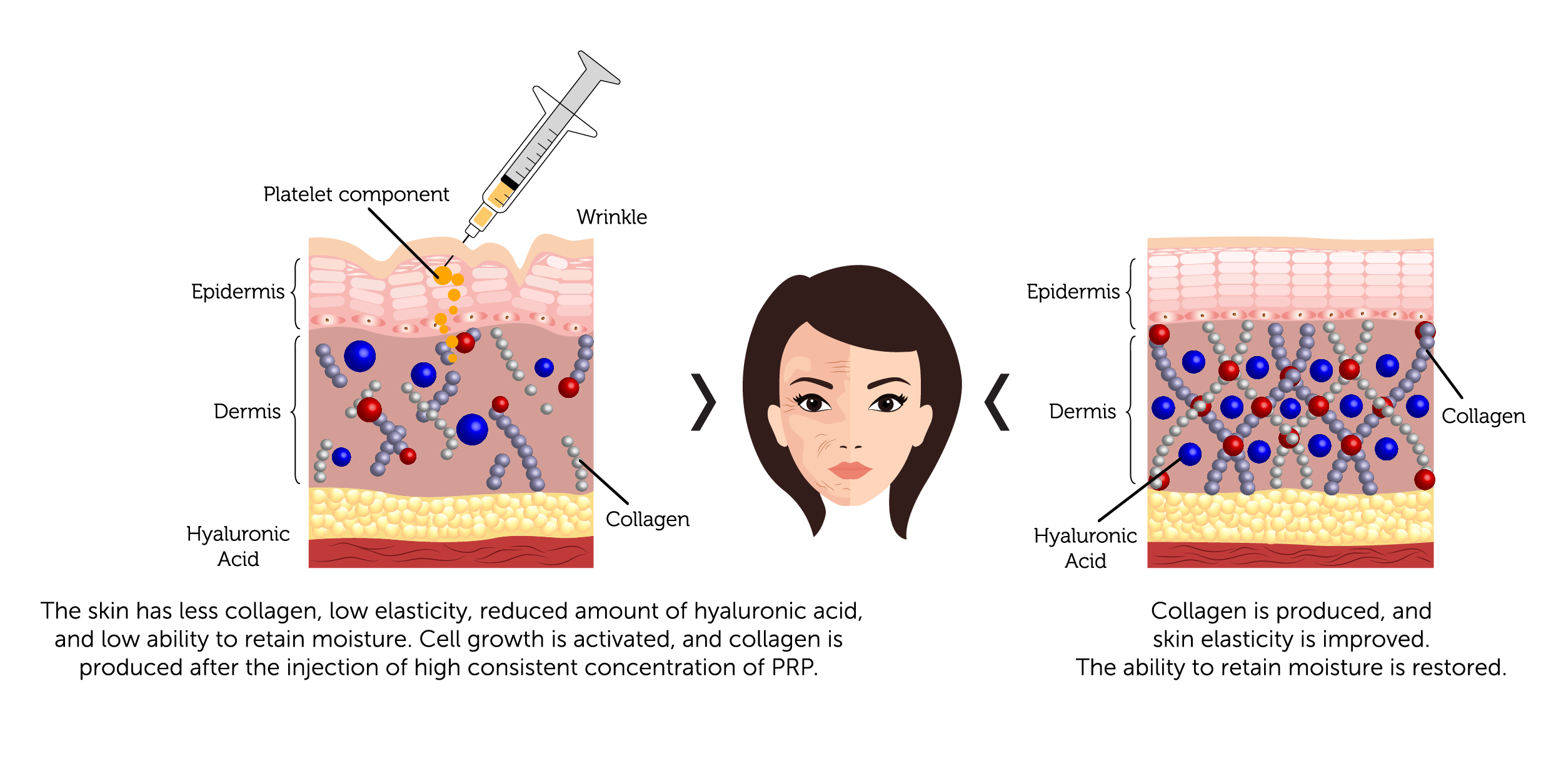 PRP Procedure for Face 1-01