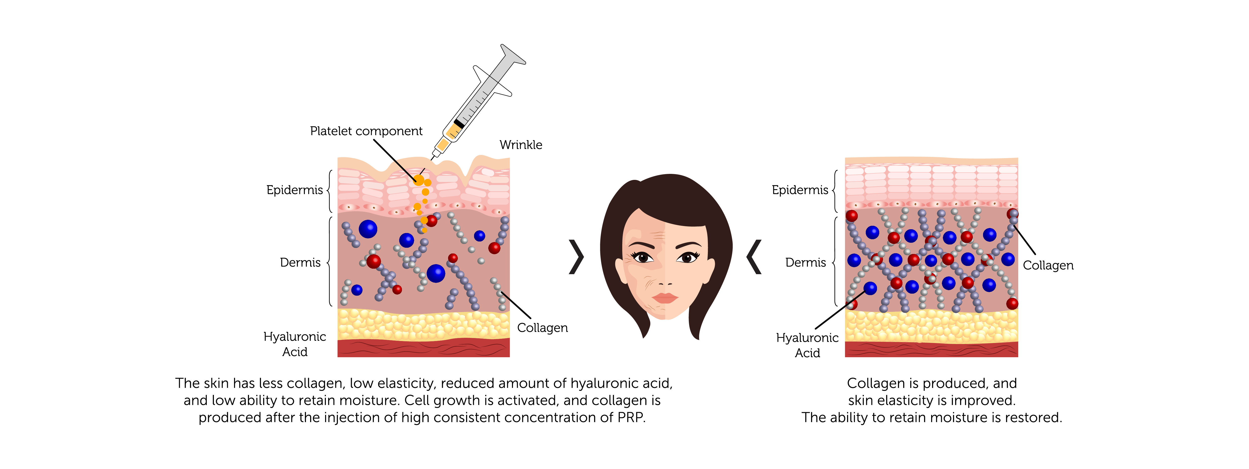 PRP Procedure for Face 2-01