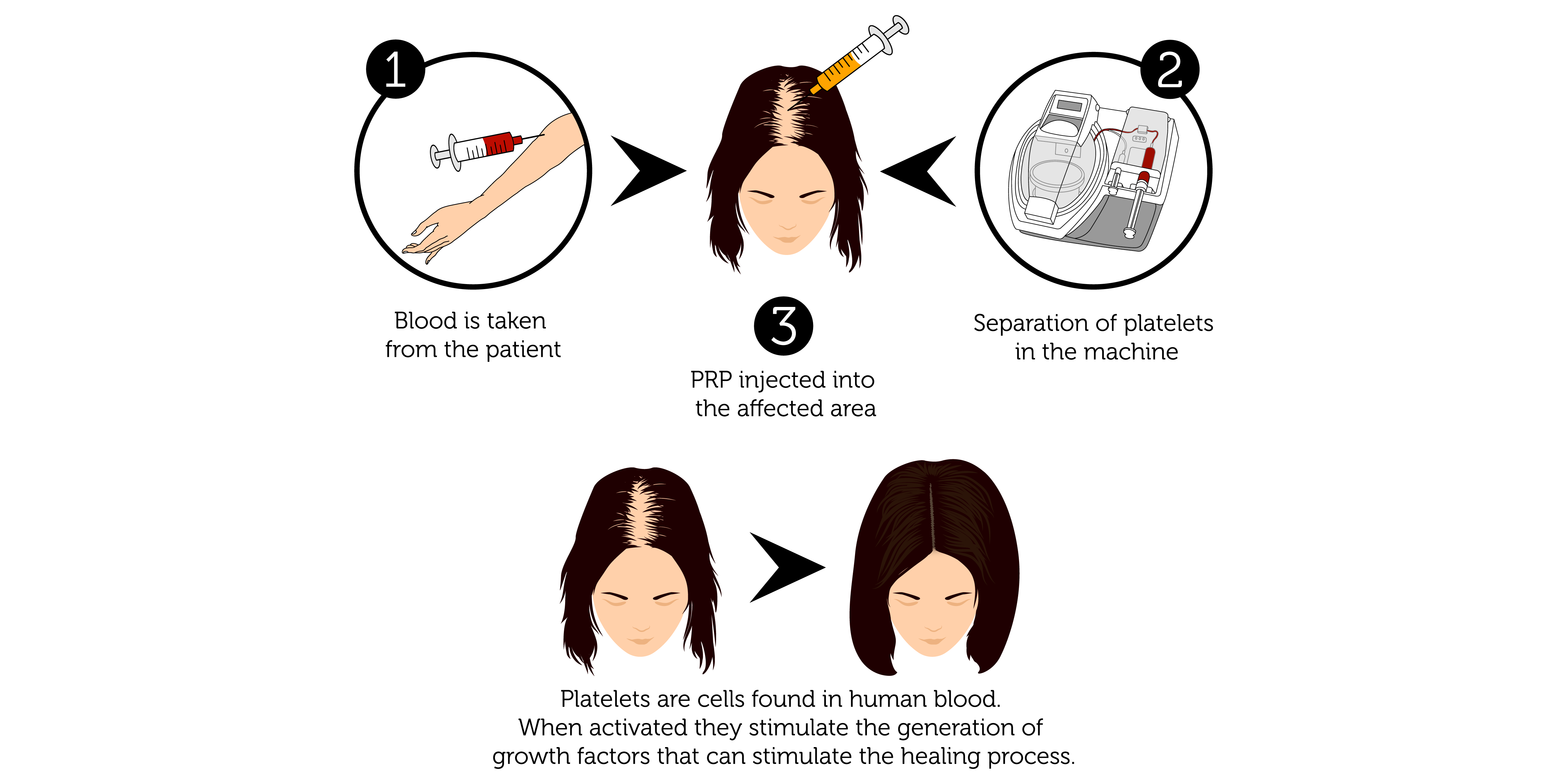 PRP Procedure for Hair (Female)-01