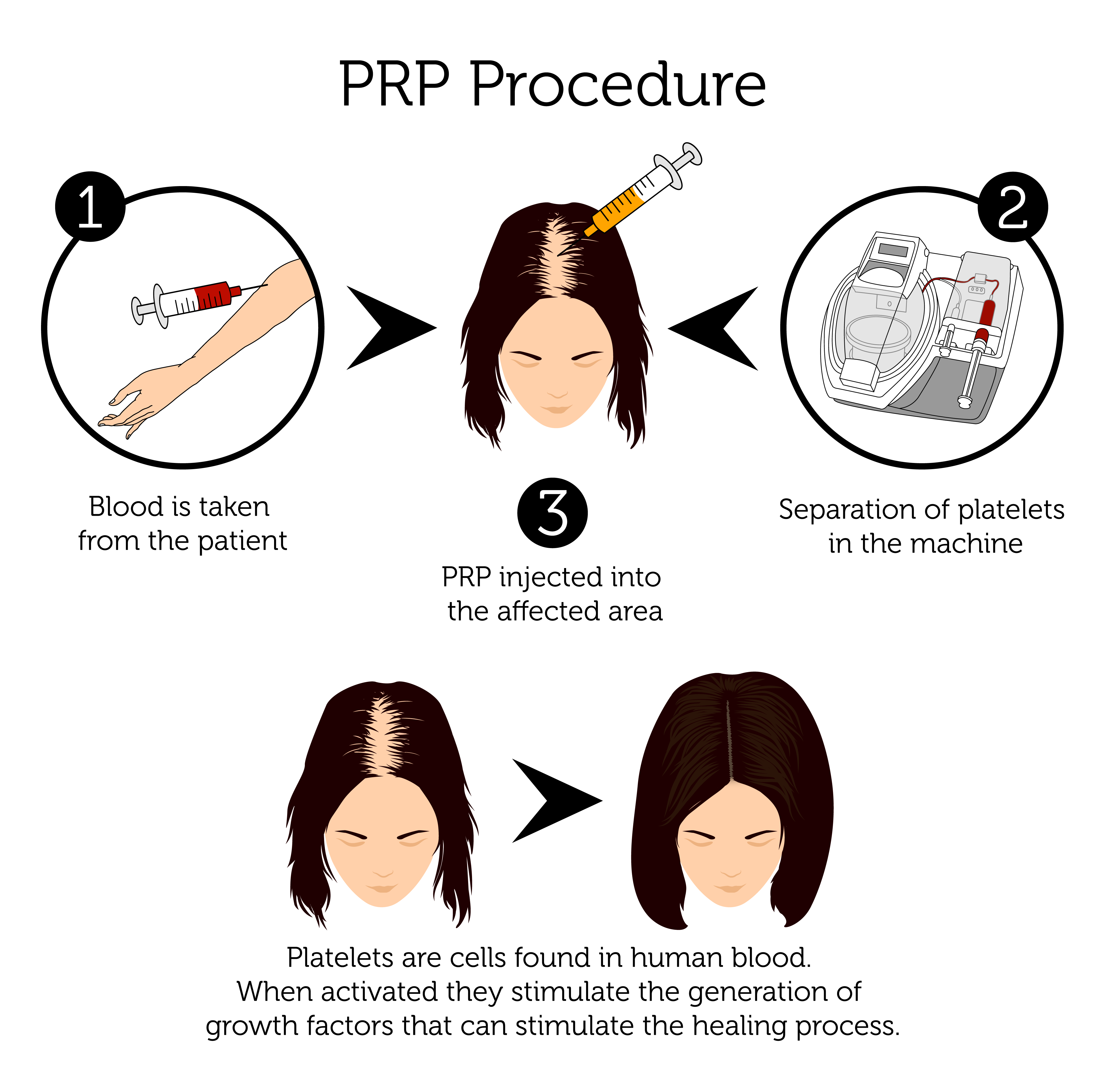PRP Procedure for Hair (Female)