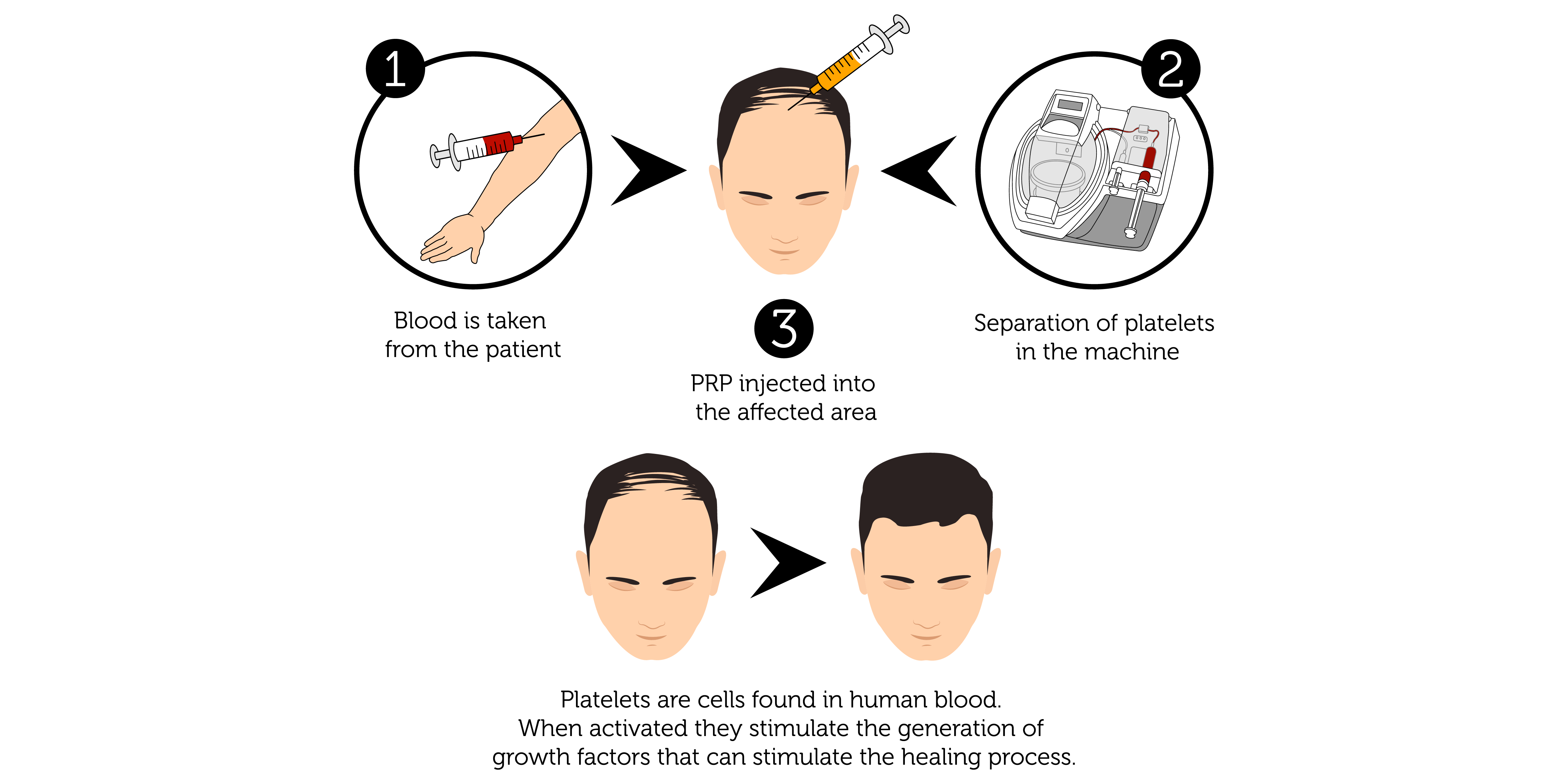 PRP Procedure for Hair (Male)-01