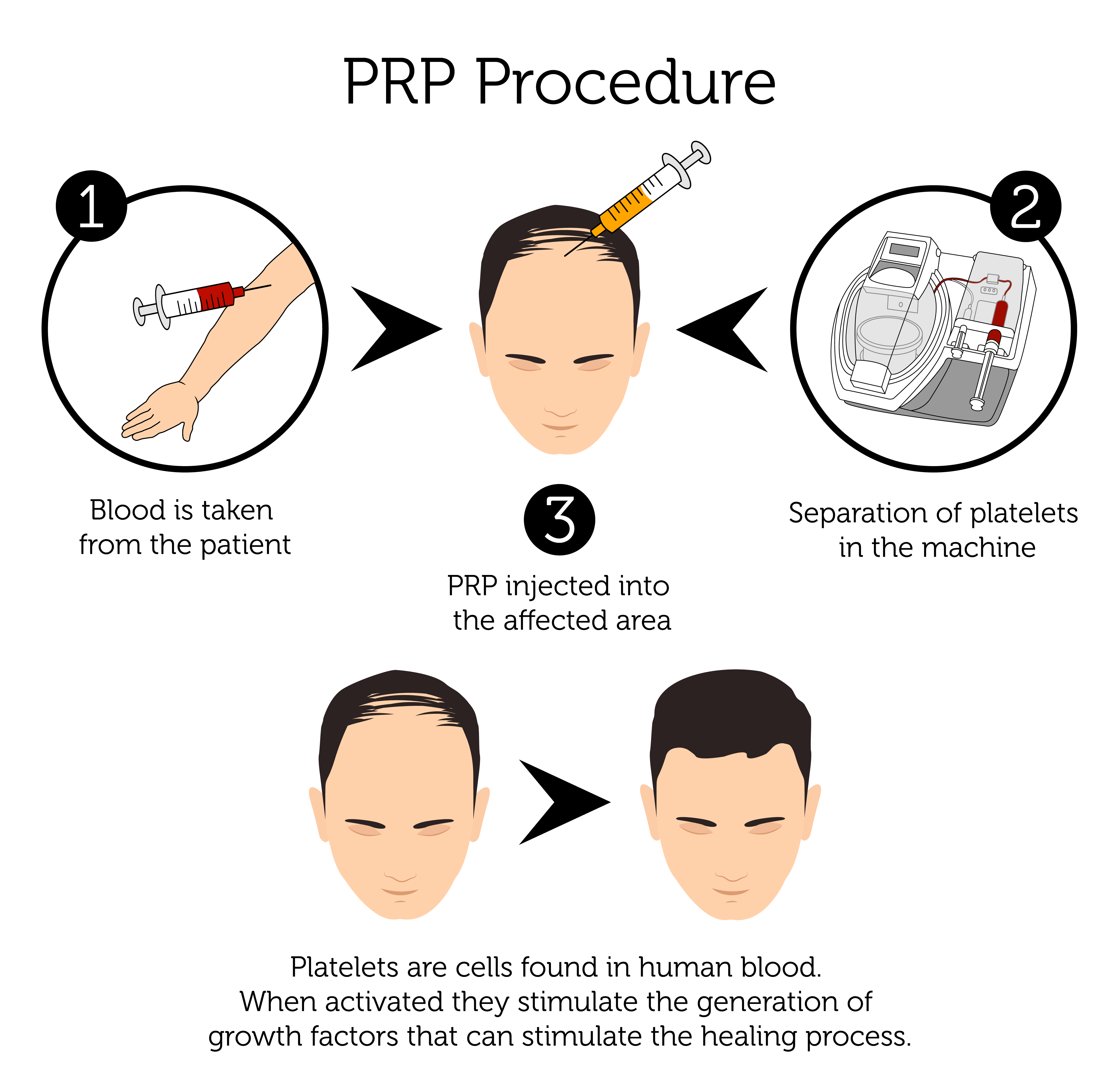 PRP Hair Loss Before  After Photos Male  Female Platelet Rich Plasma  for Hair