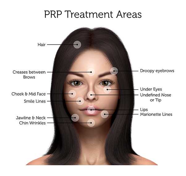 PRP Treatment Areas (Female)