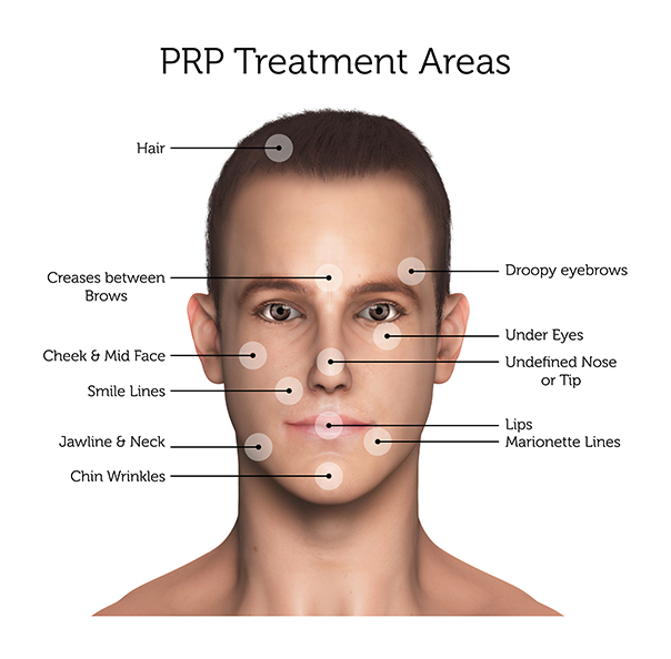 PRP Treatment Areas (Male)