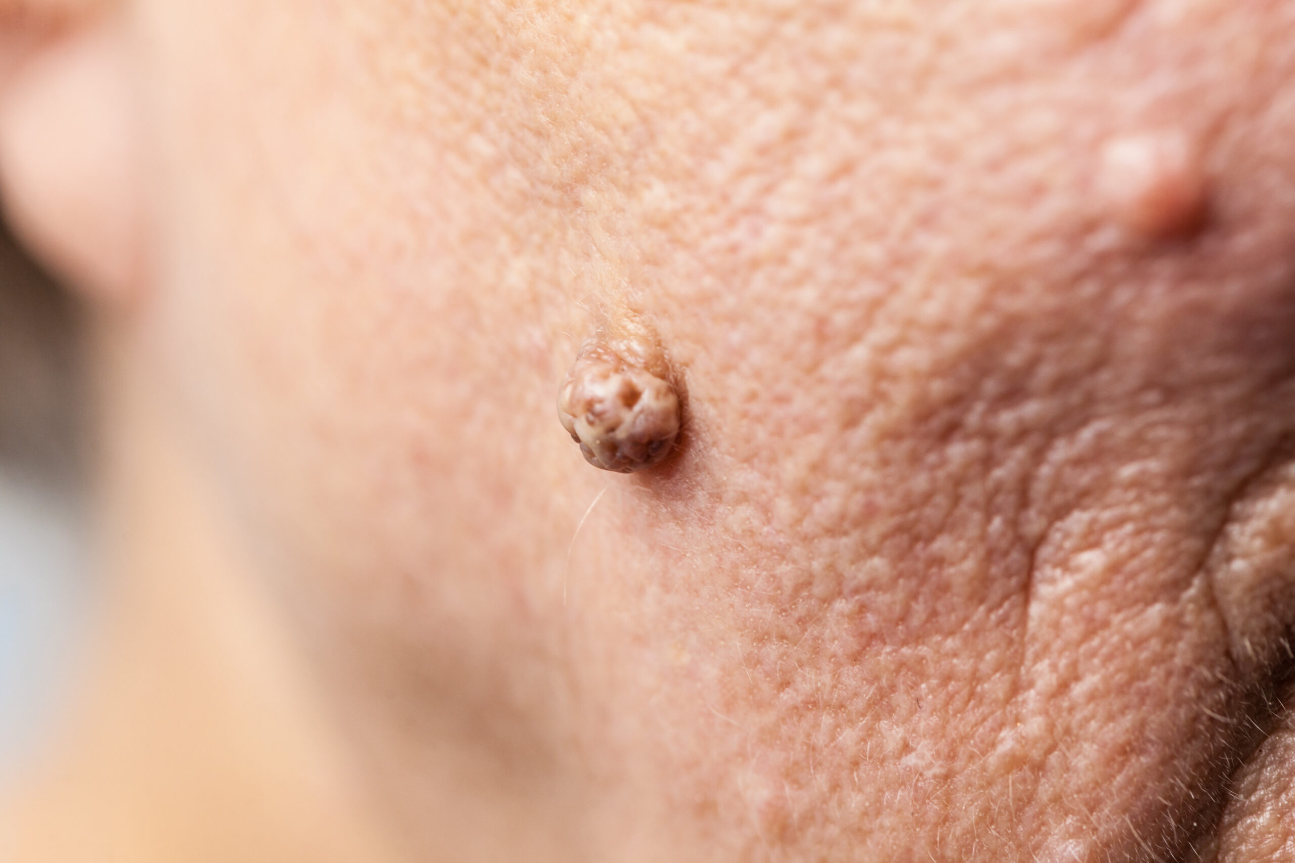 Skin tags & Warts