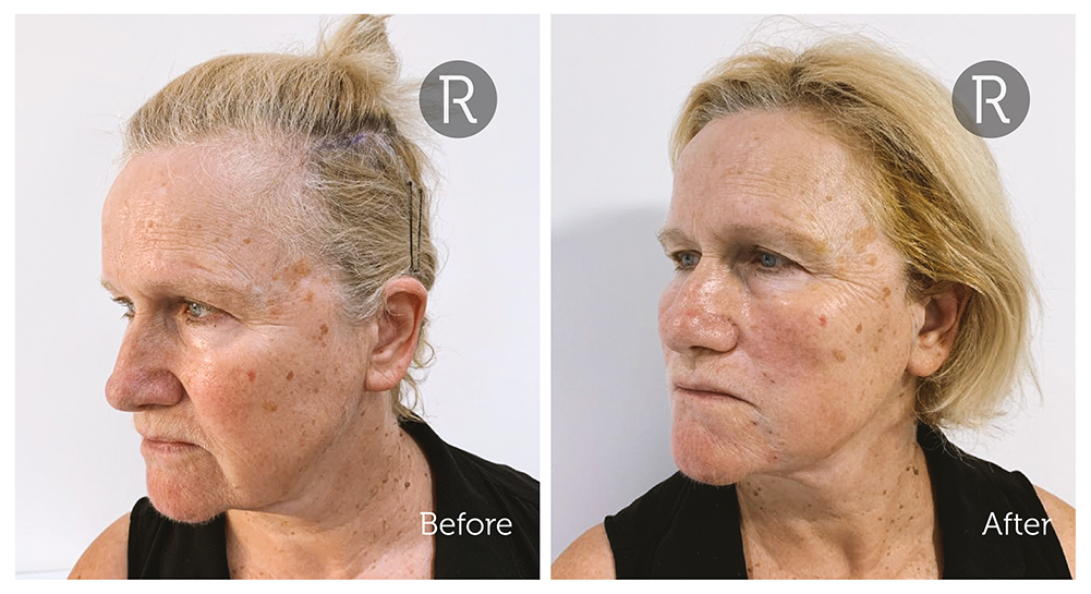 Thread & Lift - The 1st real facelift without surgery