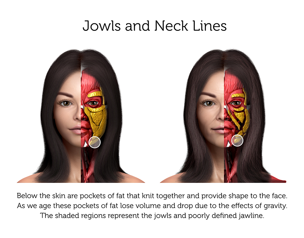 Jowls and Neck Lines (Female) 2