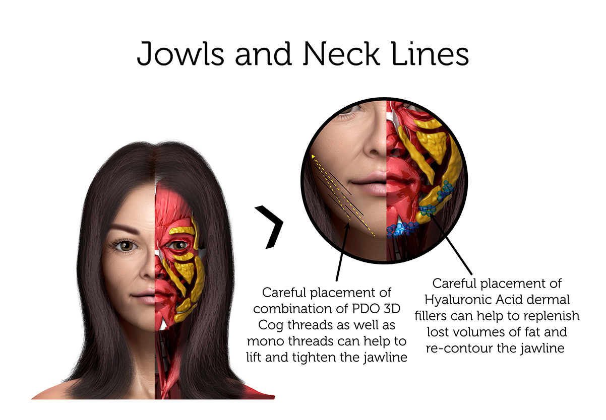 Jowls and Neck Lines (Female) 3