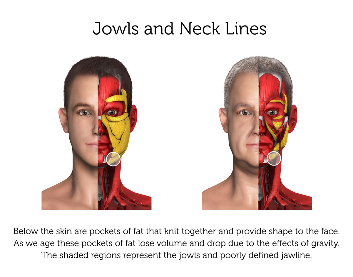 Jowls and Neck Lines (Male) 2