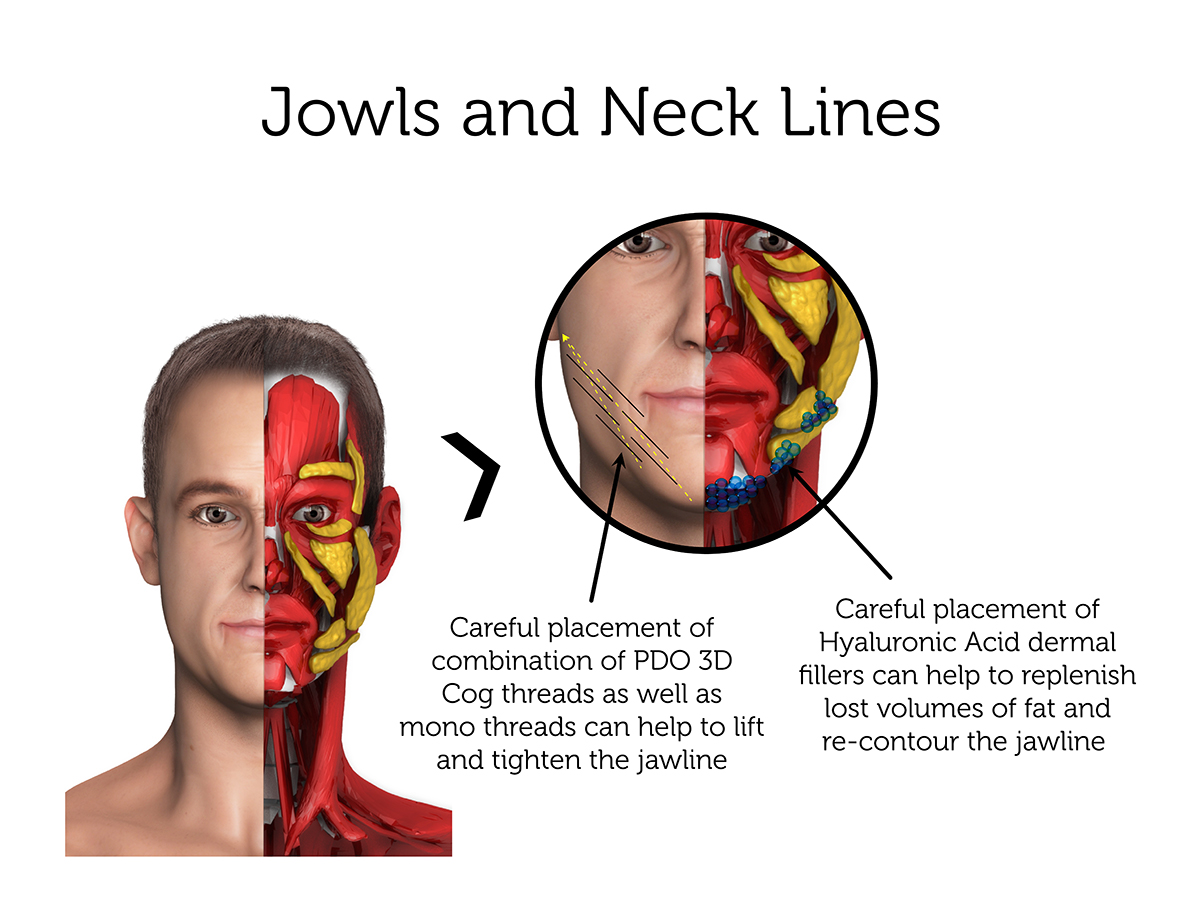 Jowls and Neck Lines (Male) 3