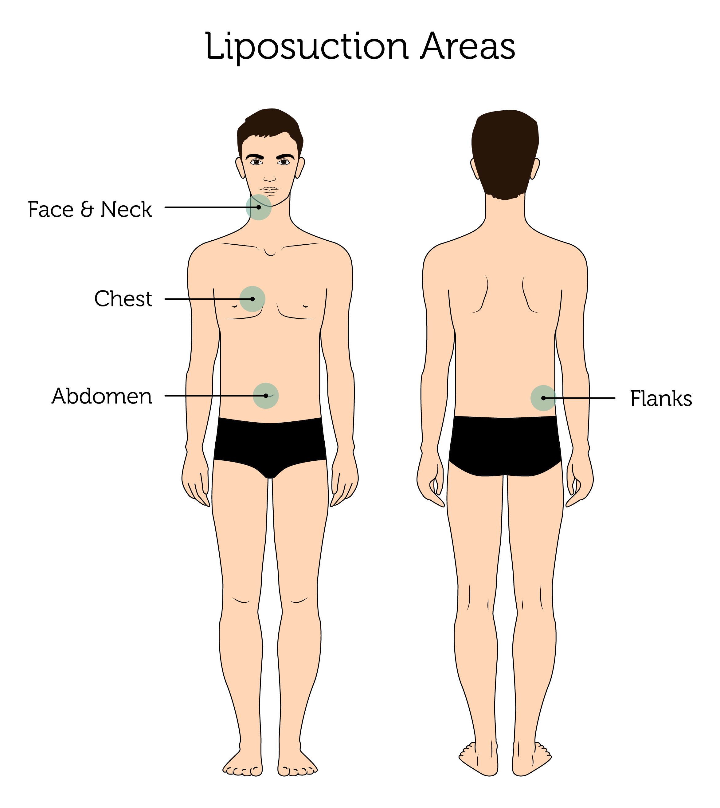 Liposuction Areas (Male)-01