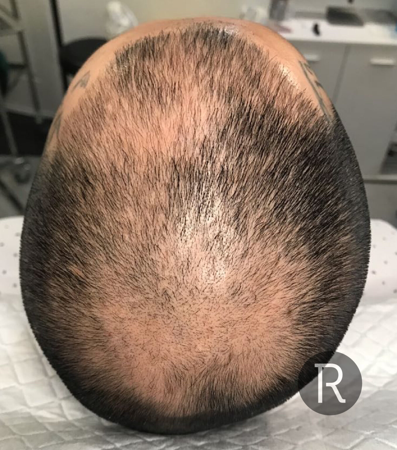 Advanced PRP Hair Treatment London, UK Rejuvence Clinic