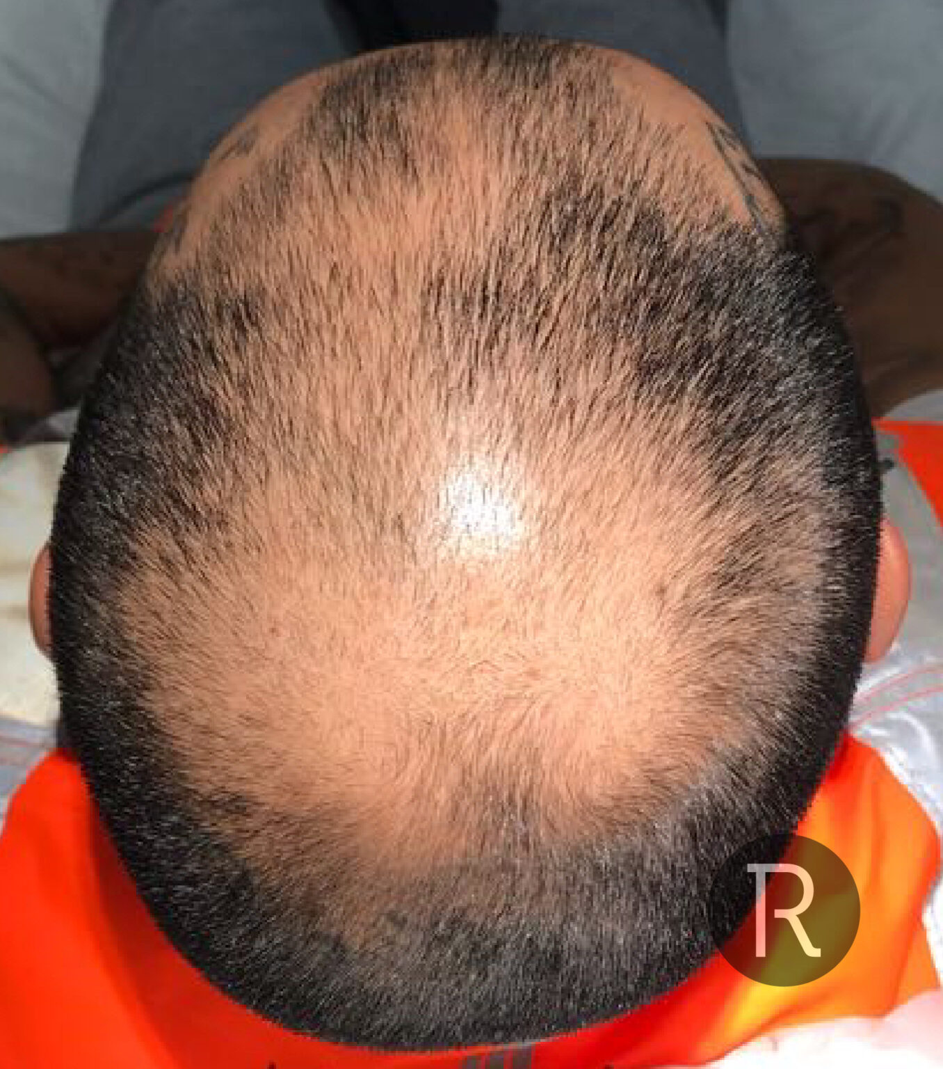 Advanced PRP Hair Treatment London, UK Rejuvence Clinic