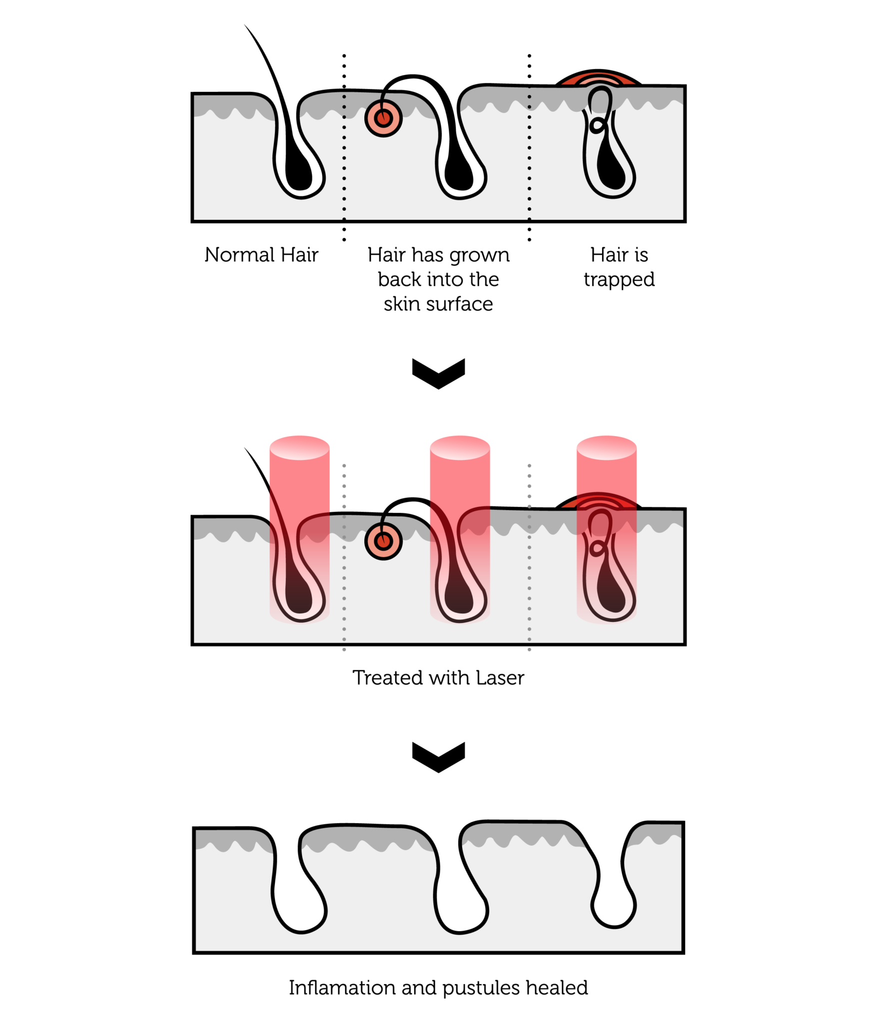 Medical Laser Hair Removal London, UK Rejuvence Clinic