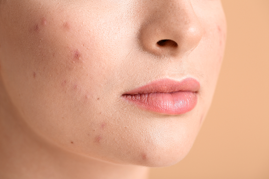 Laser Treatment for Acne in London, UK
