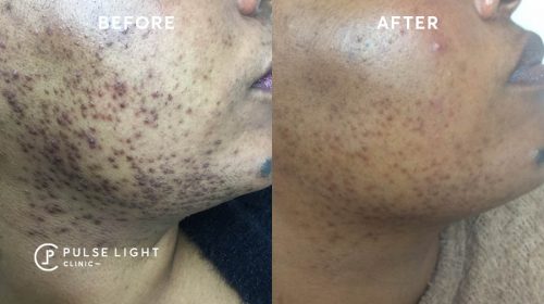 WEB Hair Ingrown September145 500x280 1