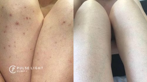 WEB LaserHairRemoval NewSize August12 900x505 High21 500x280 1